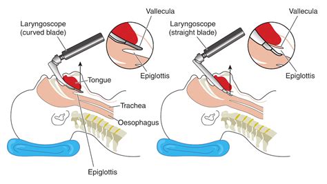 Laryngoscopy: Procedure, Definition & Types